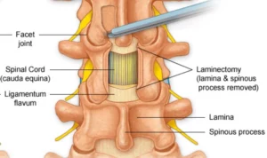 لامینکتومی