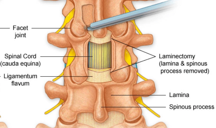 لامینکتومی