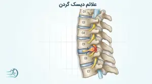 علائم دیسک گردن چیست؟