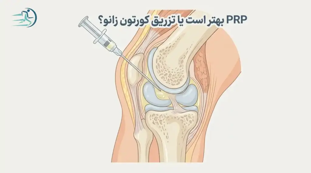 PRP بهتر است یا تزریق کورتون زانو؟