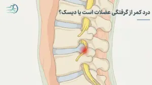 درد کمر از گرفتگی عضلات است یا دیسک؟