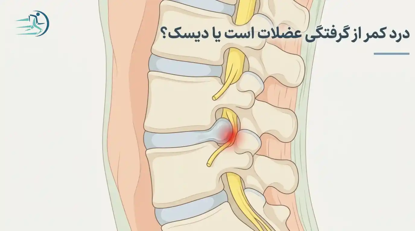 درد کمر از گرفتگی عضلات است یا دیسک؟